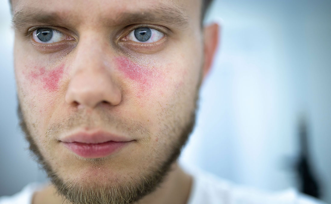 Persona affetta da Lupus
