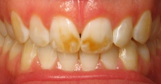 pigmentazione denti